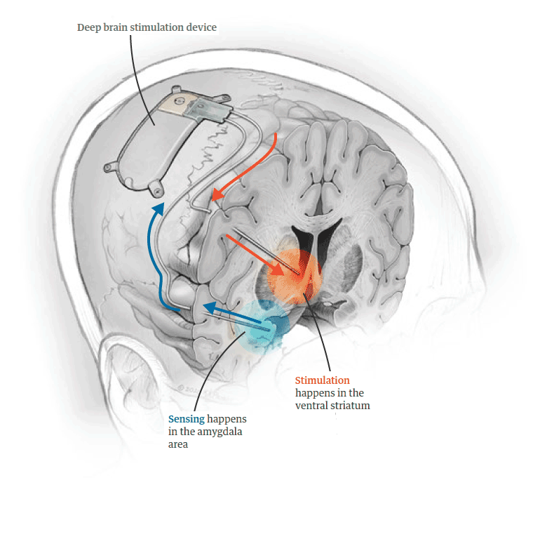 NeuroPace DBS